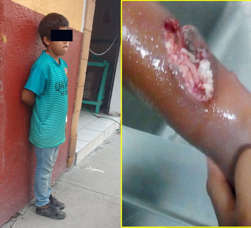 ¡Niño lesionado tras ser atacado y mordido por un perro en Lagos de Moreno!