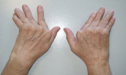 ¡Llevar una vida sana evita la artritis reumatoide!