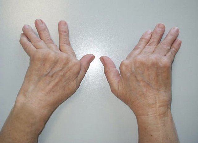 ¡Llevar una vida sana evita la artritis reumatoide!