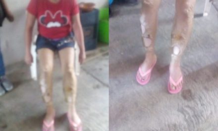 ¡Mujer sufrió quemaduras en el 45 por ciento de su cuerpo tras un flamazo en Aguascalientes!