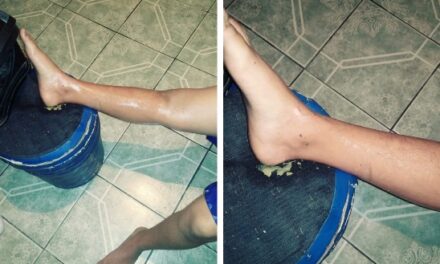 ¡Niño de 10 años de edad sufrió quemaduras en una pierna tras caerle encima aceite hirviendo en Aguascalientes!